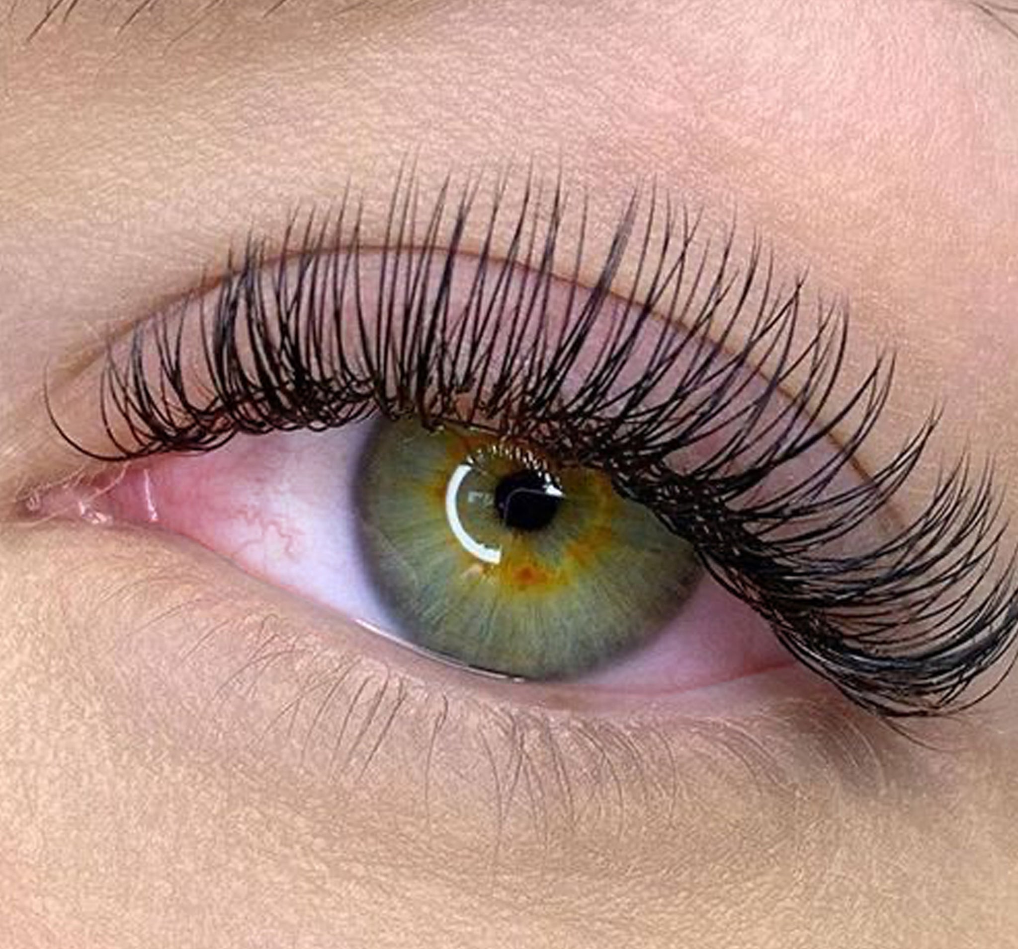 Allergic reaction after eyelash extensions