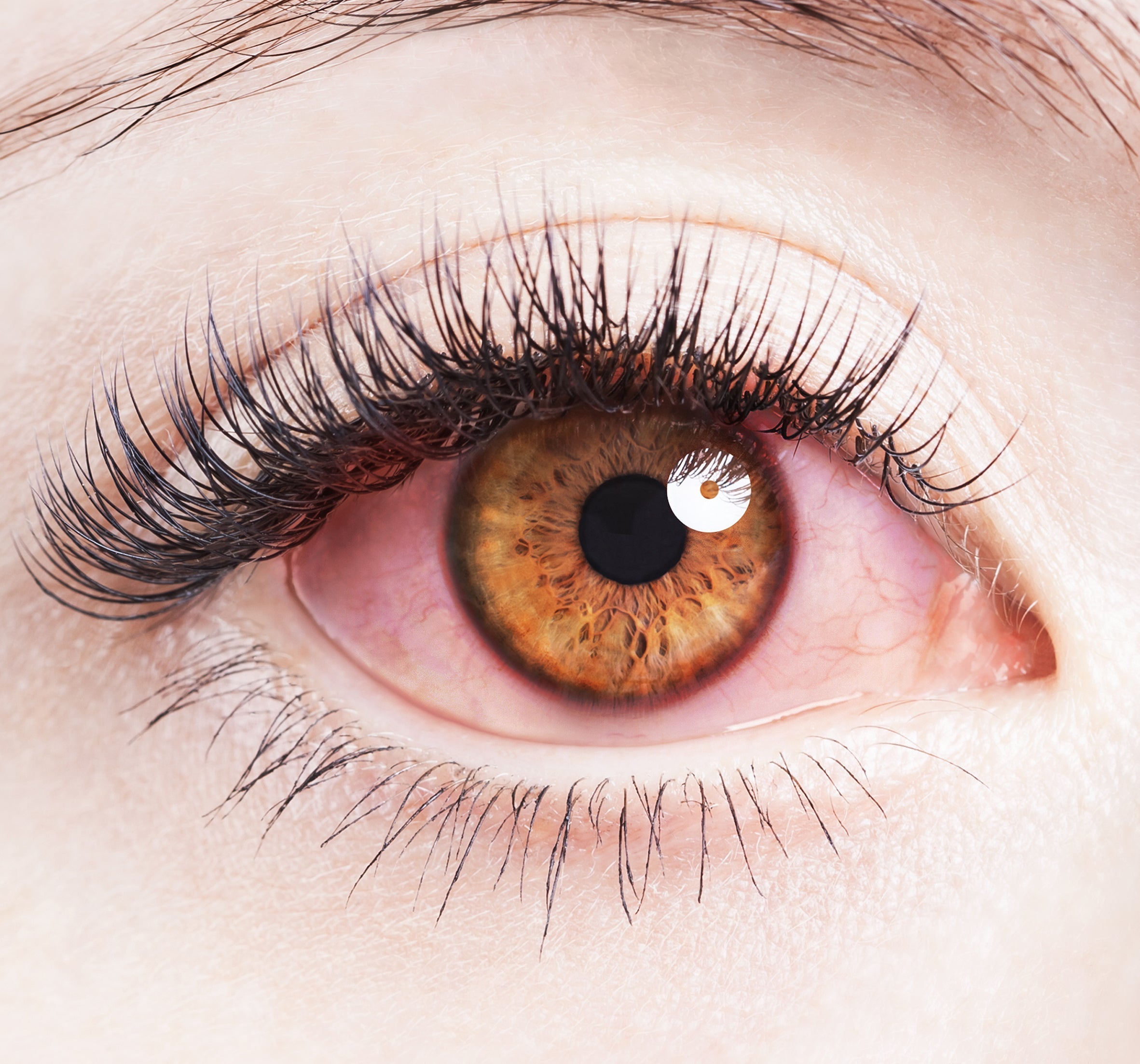 an irritated eye with extensions on