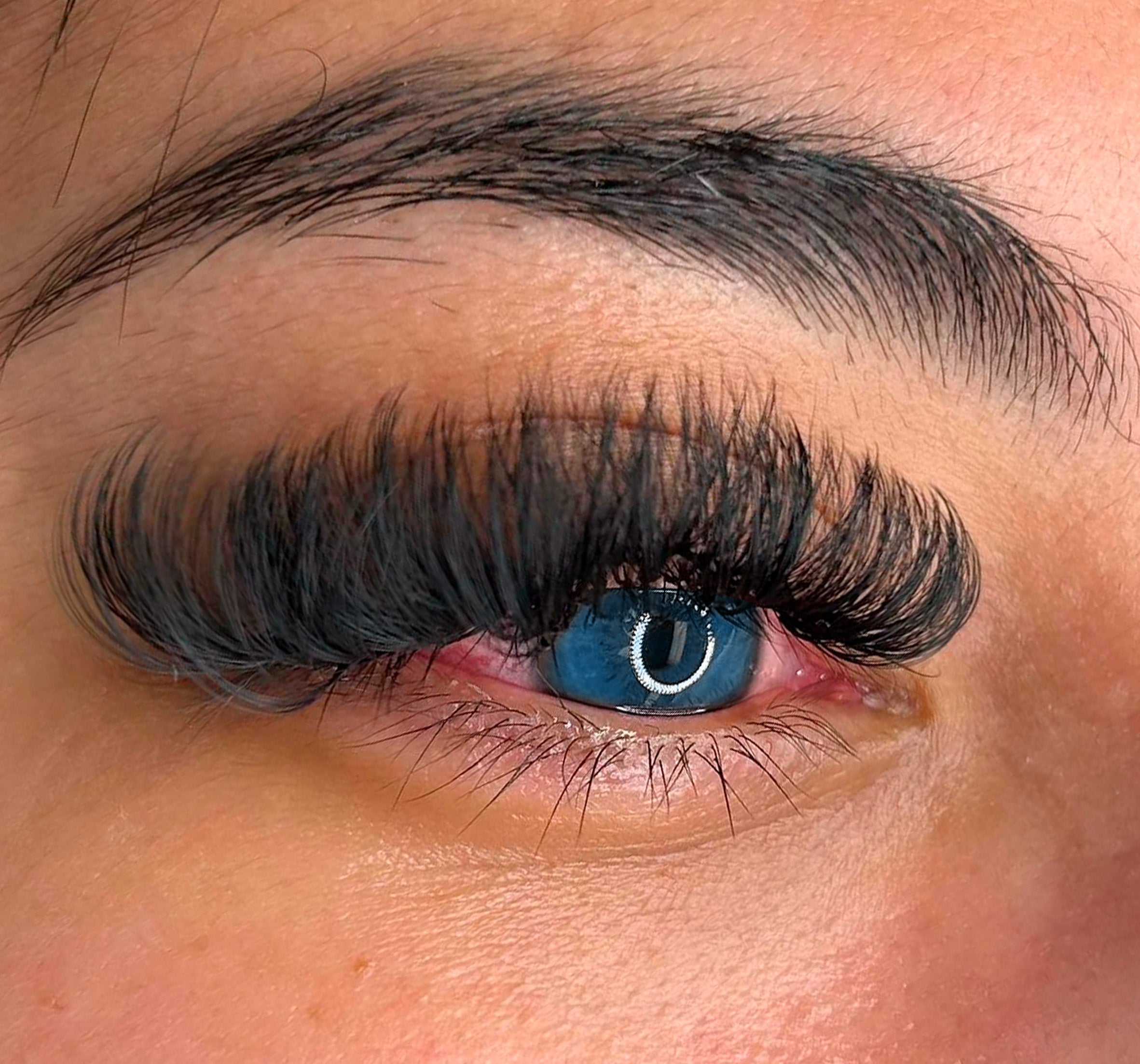 an irritated eye with lash extensions